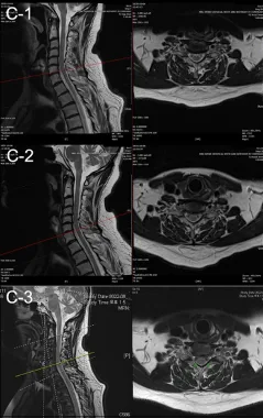 Recurrent-remitting multiple sclerosis with a 28-year history