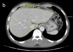 Hepatitis B-Associated Cirrhosis with Fibrin Deposition