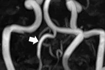 Vertebral Artery Dissection Recurring After 16 Years