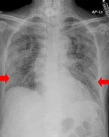 Acute Respiratory Distress Syndrome Caused by COVID-19
