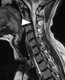 Chronic complete quadriplegia resulting from complications of tuberculosis